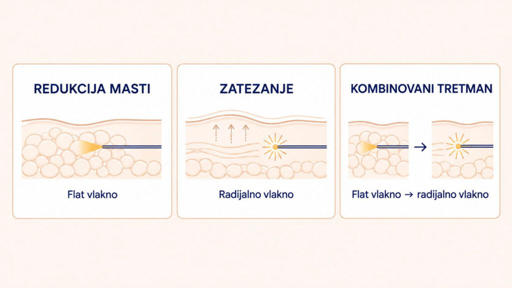 Endolift za topljenje masnih naslaga i zatezanje kože.