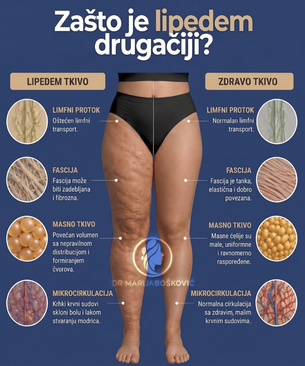 Izgled lipedema.