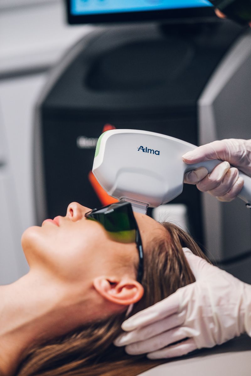 Tretman Alma Dye VL laserom u ordinaciji dr Marije Bošković.