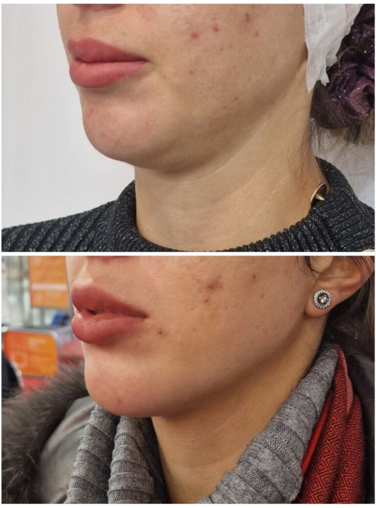 endolift-pre-posle