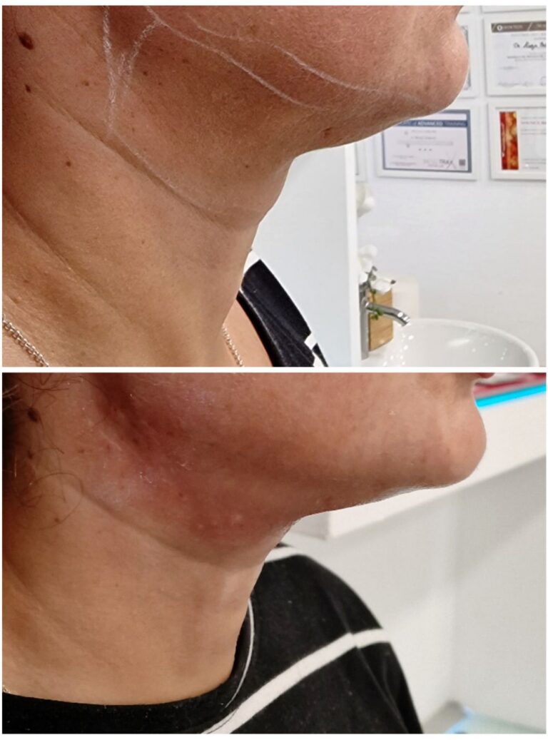 endolift-tretman-pre-posle