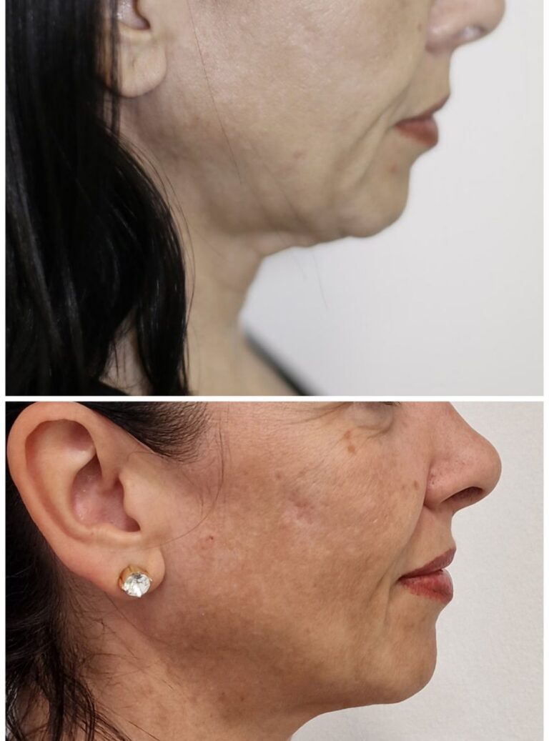 pre-posle-endolift