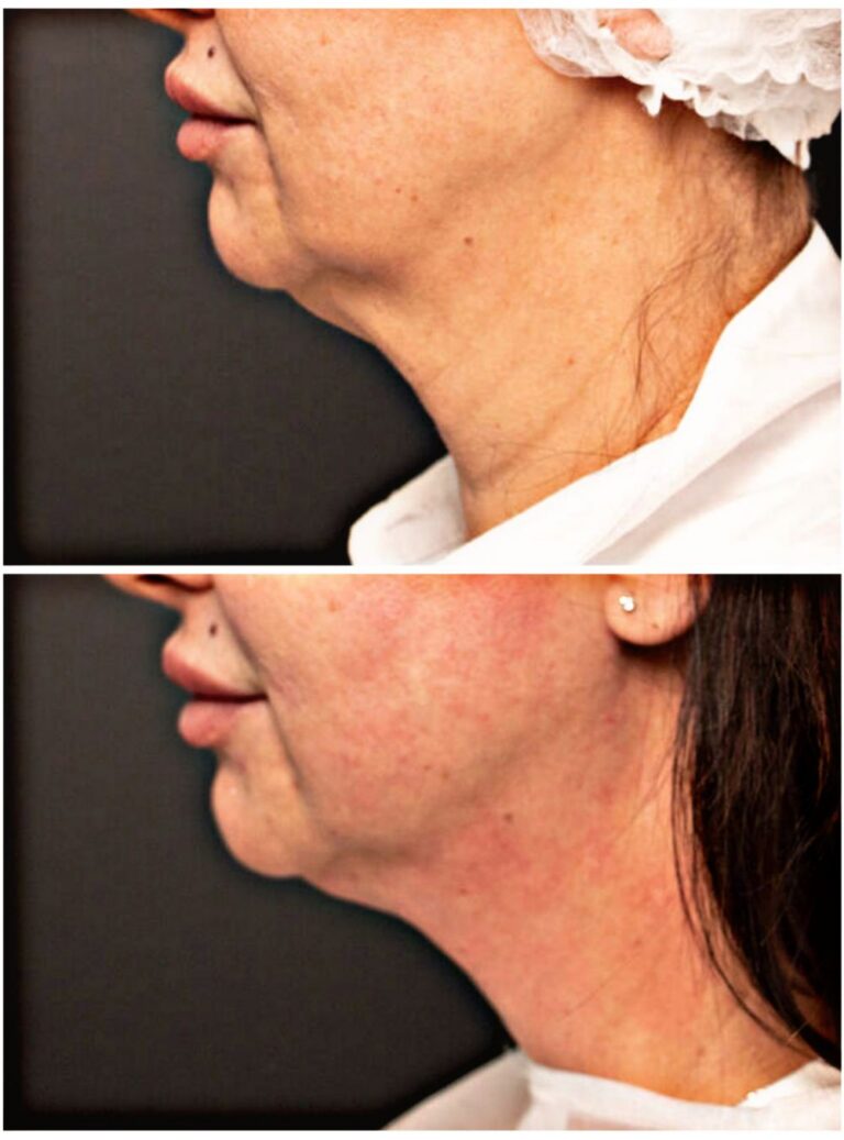 pre-posle-endolift-tretman